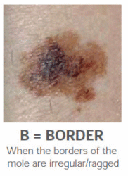 SkinCancer Border